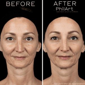 Polyphil philart skin booster treatments in cork