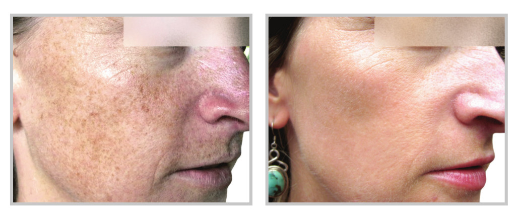 Moxi laser treatment cork