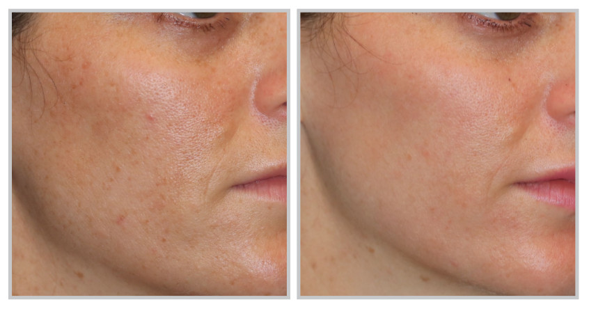 Moxi laser treatment cork