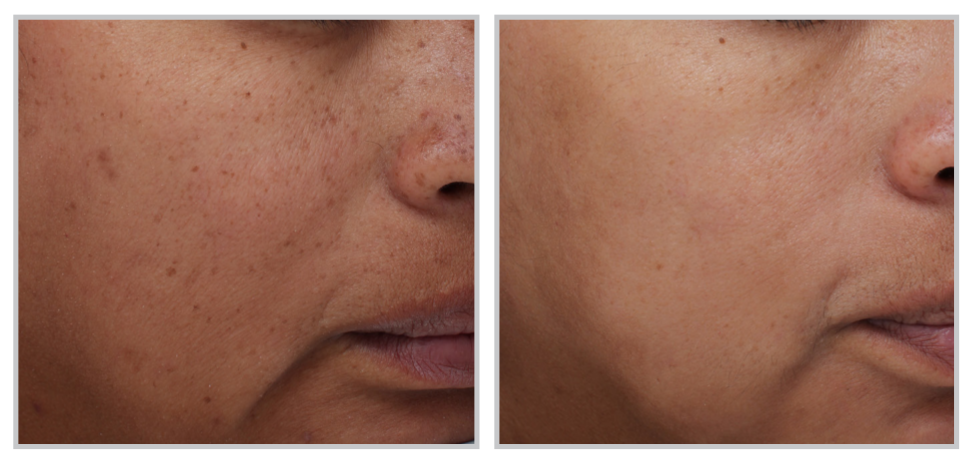 Bbl & moxi stack laser treatment for radiant skin